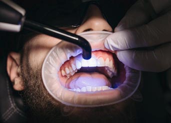 4 Benefits of Professional Teeth Whitening | Moreno Valley